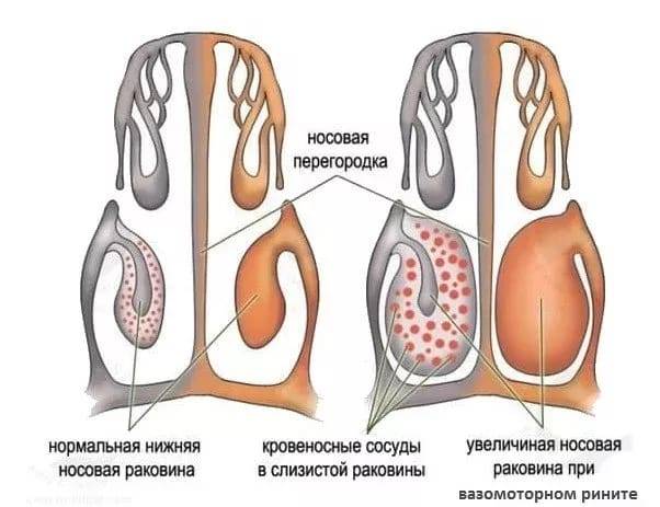 Ринит аллергический - описание, причины, диагностика, лечение.