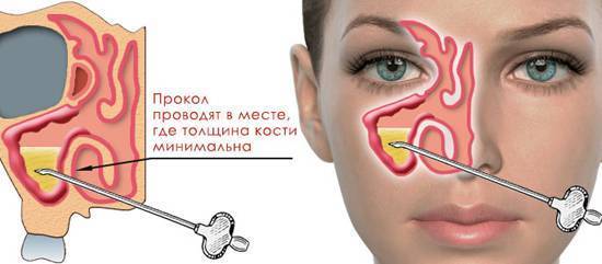 Эффективное средство от гайморита: список лекарств и рецептов