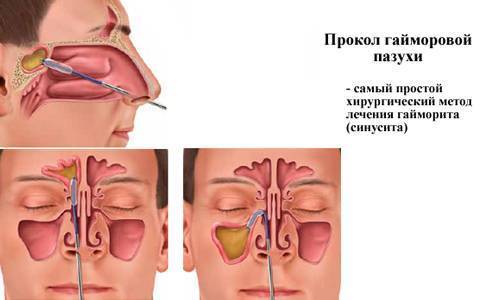 Лечение гайморита в домашних условиях у взрослых народными средствами