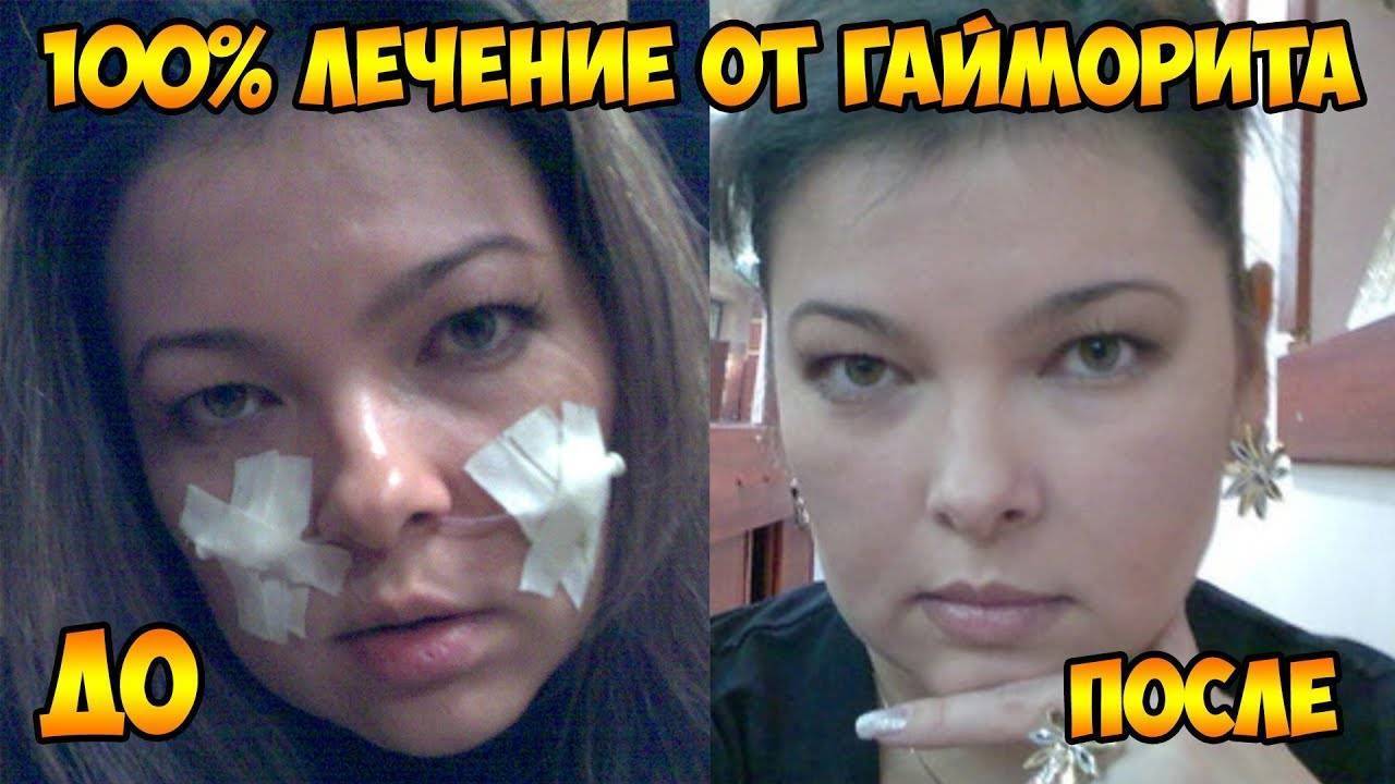 Как вылечить гайморит без прокола в домашних условиях