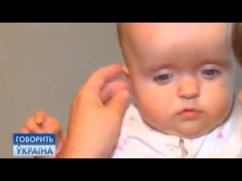 Карликовость (гипофизарный нанизм): причины, симптомы, лечение