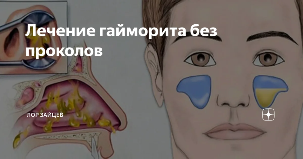Как вылечить гайморит в домашних условиях — быстро и без прокола
