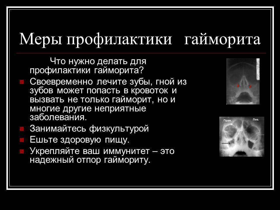 Эффективное средство от гайморита: список лекарств и рецептов