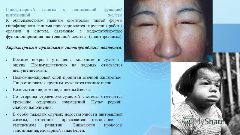 Гипофизарный нанизм: причины заболевания, основные симптомы, лечение и профилактика