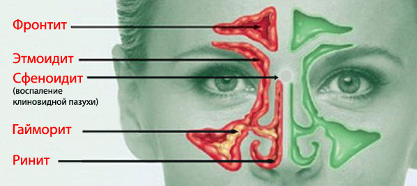 Код мкб хронический аллергический ринит