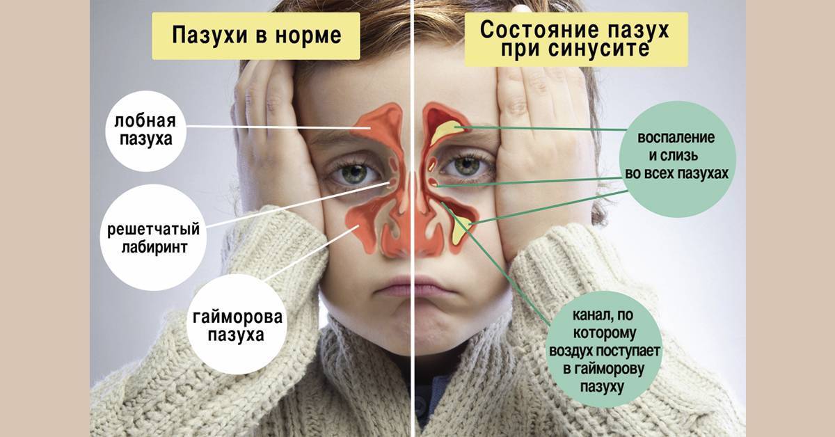 Как вылечить гайморит в домашних условиях быстро