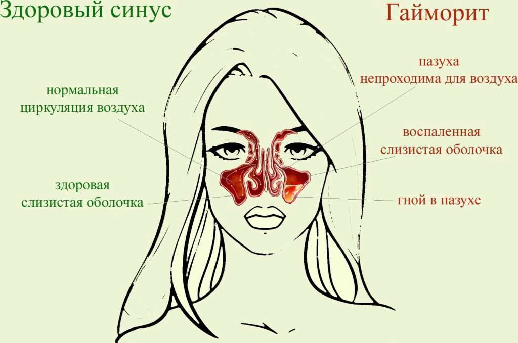 Как лечить гайморит
