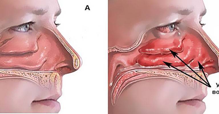 Аллергический ринит мкб-10: симптомы и лечение у взрослых и детей