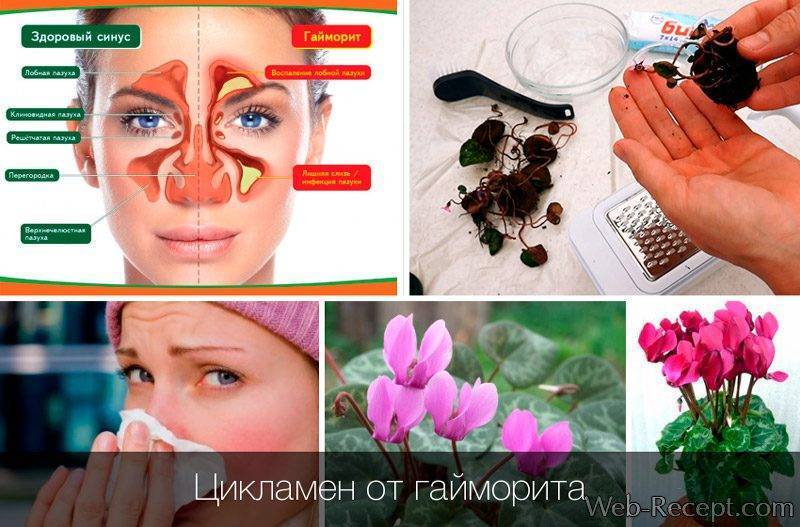 Как вылечить гайморит в домашних условиях быстро