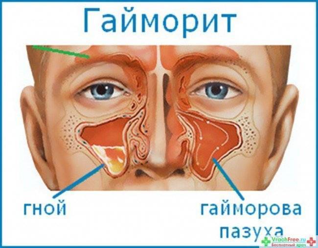 Средство от гайморита в домашних условиях – что можно применить?