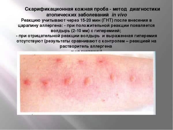 Аллергический ринит мк-10, классификация, в том числе вазомоторный, хронический и острый вид насморка