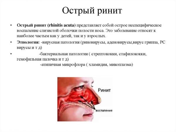 Аллергический ринит мк-10, классификация, в том числе вазомоторный, хронический и острый вид насморка