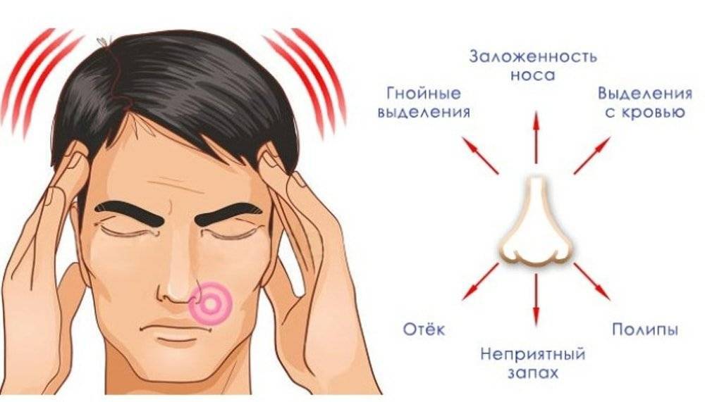 Гайморит у детей: признаки, симптомы и правильное лечение