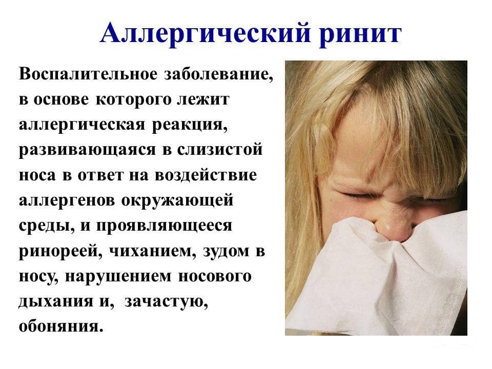 Аллергический ринит мк-10, классификация, в том числе вазомоторный, хронический и острый вид насморка