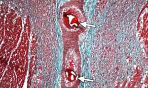 Микроинфаркт – симптомы и первые признаки