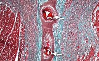 Микроинфаркт – симптомы и первые признаки