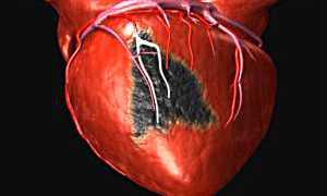 Инфаркт – симптомы и первые признаки
