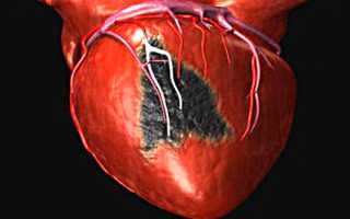 Инфаркт – симптомы и первые признаки