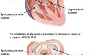 Миксоматозная дегенерация митрального клапана