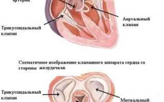 Миксоматозная дегенерация митрального клапана