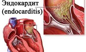 Бактериальный эндокардит