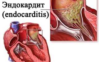Бактериальный эндокардит
