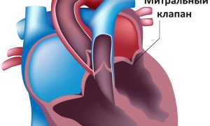 Симптомы пролапса митрального клапана