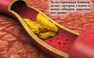 Гиперхолестеринемия