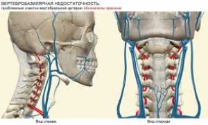 Вертебро-базилярная недостаточность