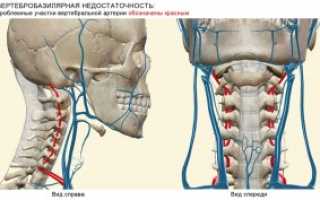 Вертебро-базилярная недостаточность