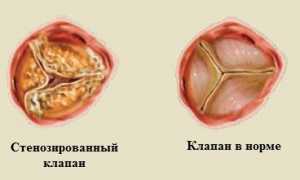 Сердечная астма: симптомы и лечение
