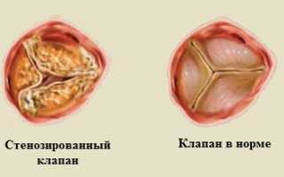Сердечная астма: симптомы и лечение