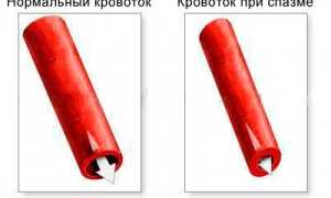 Спазм сосудов головного мозга: симптомы