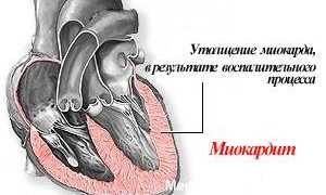 Симптомы миокардита