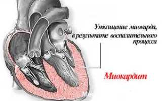 Симптомы миокардита