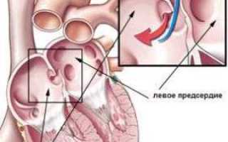 Дополнительная хорда левого желудочка