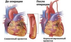 Шунтирование сосудов сердца