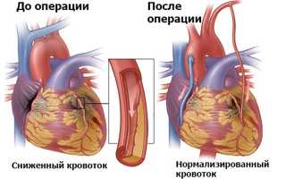 Шунтирование сосудов сердца