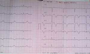 Признаки инфаркта миокарда