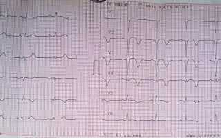 Признаки инфаркта миокарда