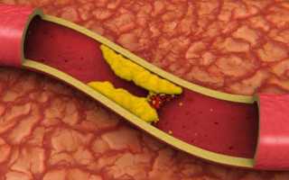 Дислипидемия – что это такое