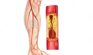 Облитерирующий эндартериит