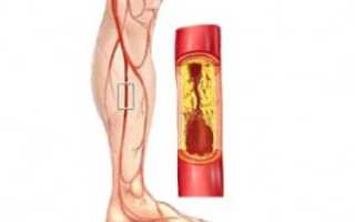 Облитерирующий эндартериит
