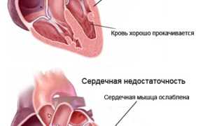 Симптомы острой сердечной недостаточности