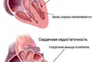 Симптомы острой сердечной недостаточности