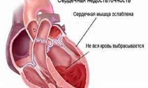 Лечение отеков ног при сердечной недостаточности