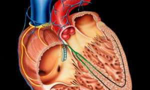 Симптомы и лечение миокардиодистрофии