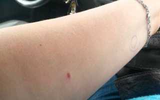 Через какое время проявляется след от манту?