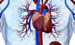 Диффузный кардиосклероз