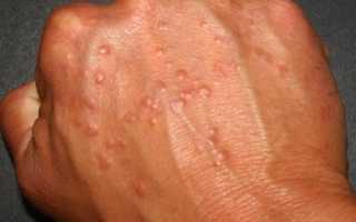 Аллергический дерматит: симптомы и лечение аллергического дерматита у детей и взрослых